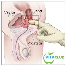 prostata simptome)